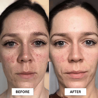 TAVILO™ CONTOUR 7 LIGHT THERAPY MASK