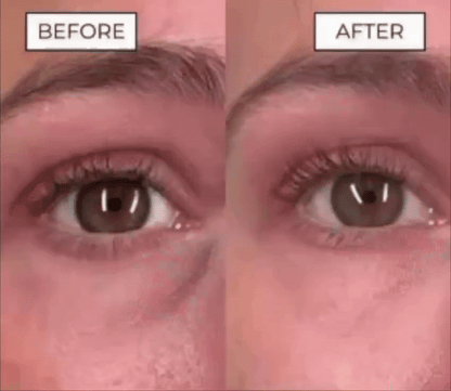 TAVILO™ THERAPY UNDER-EYE GLASSES